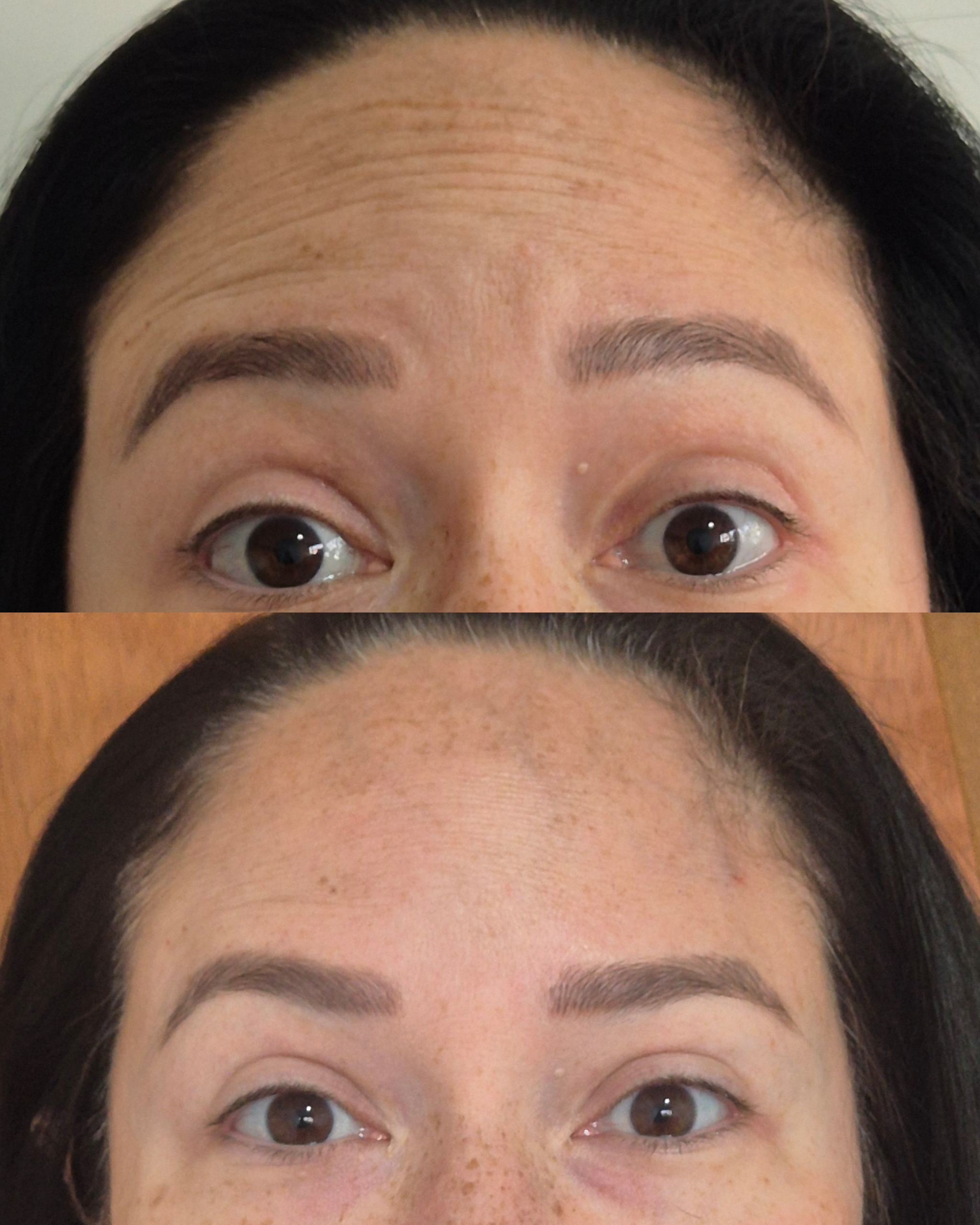 Resultado Harmonização Facial