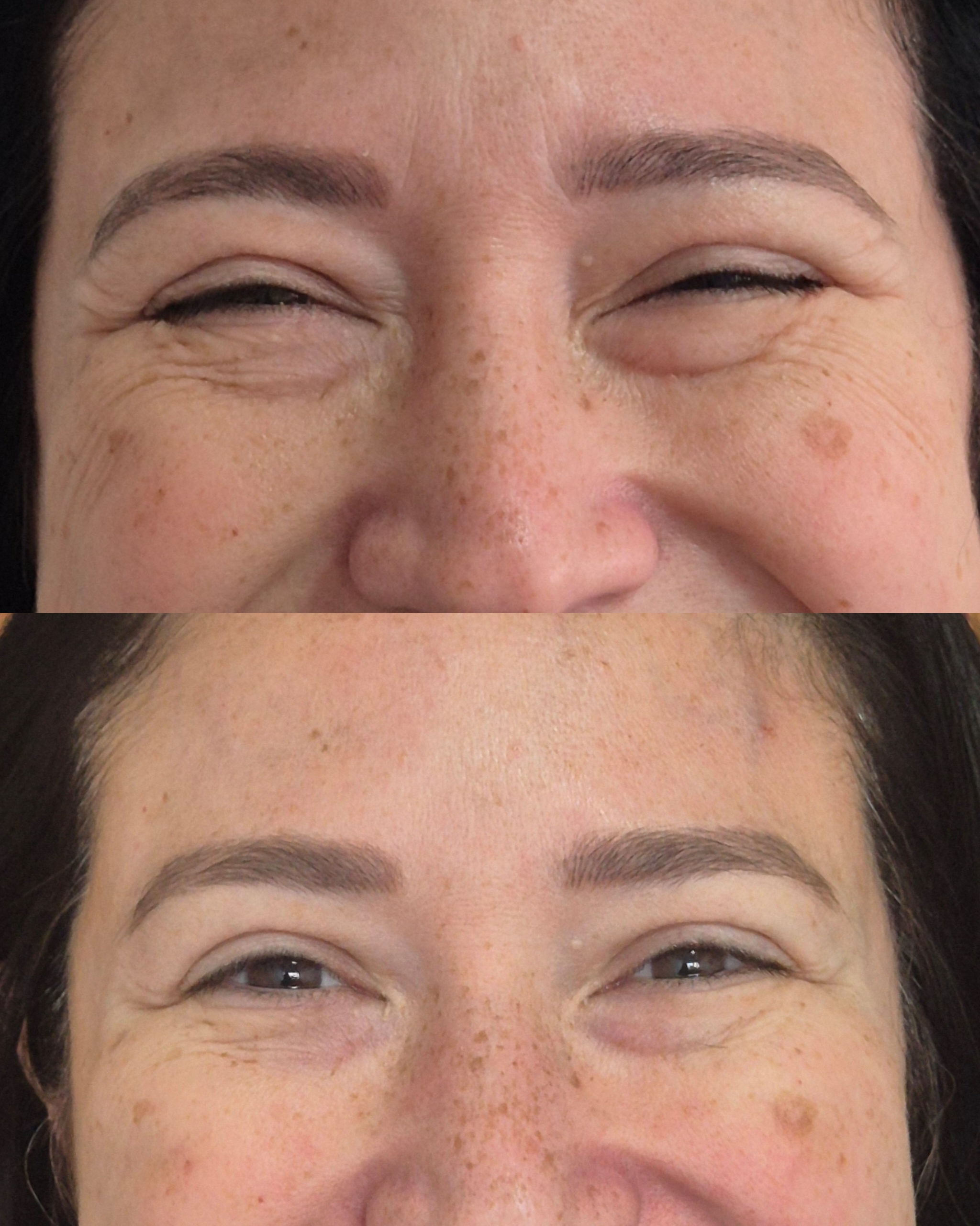 Resultado Harmonização Facial