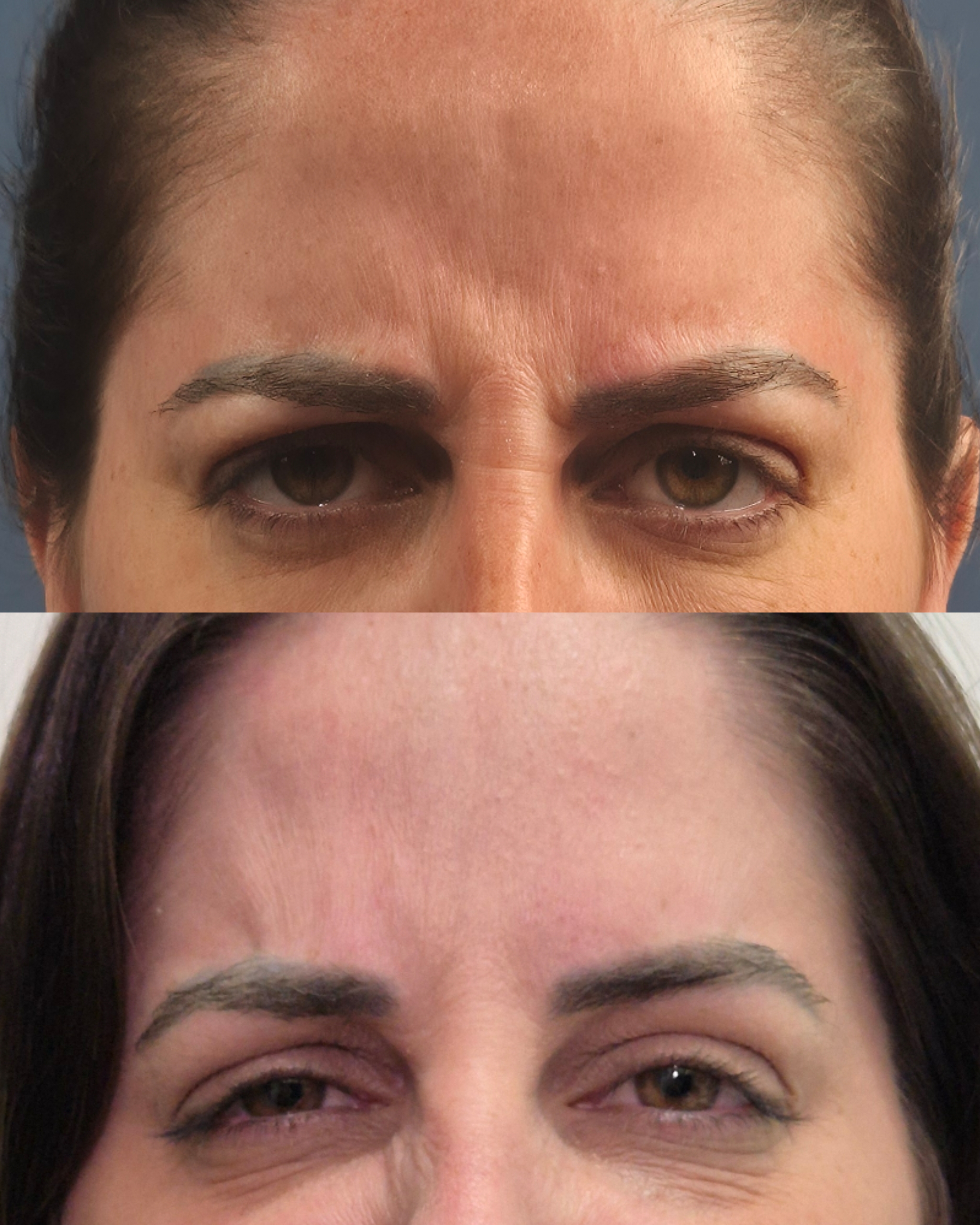 Resultado Harmonização Facial