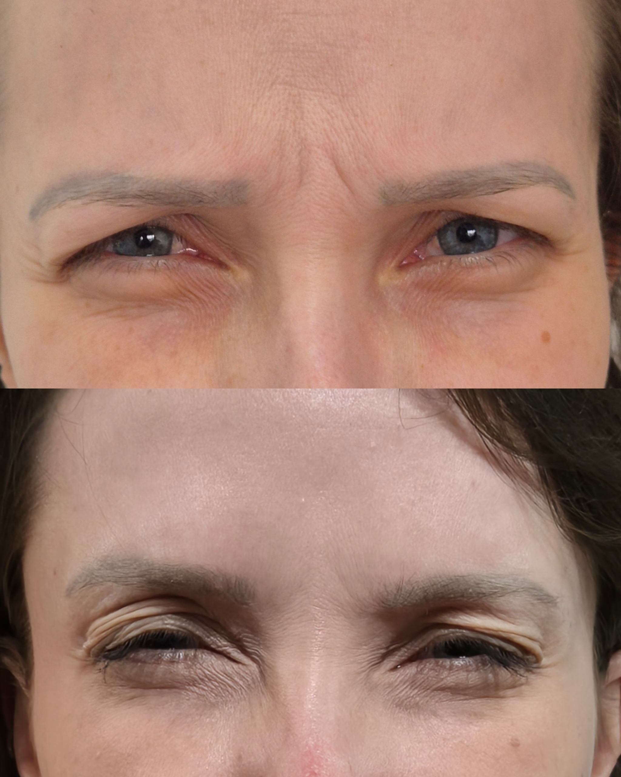 Resultado Harmonização Facial