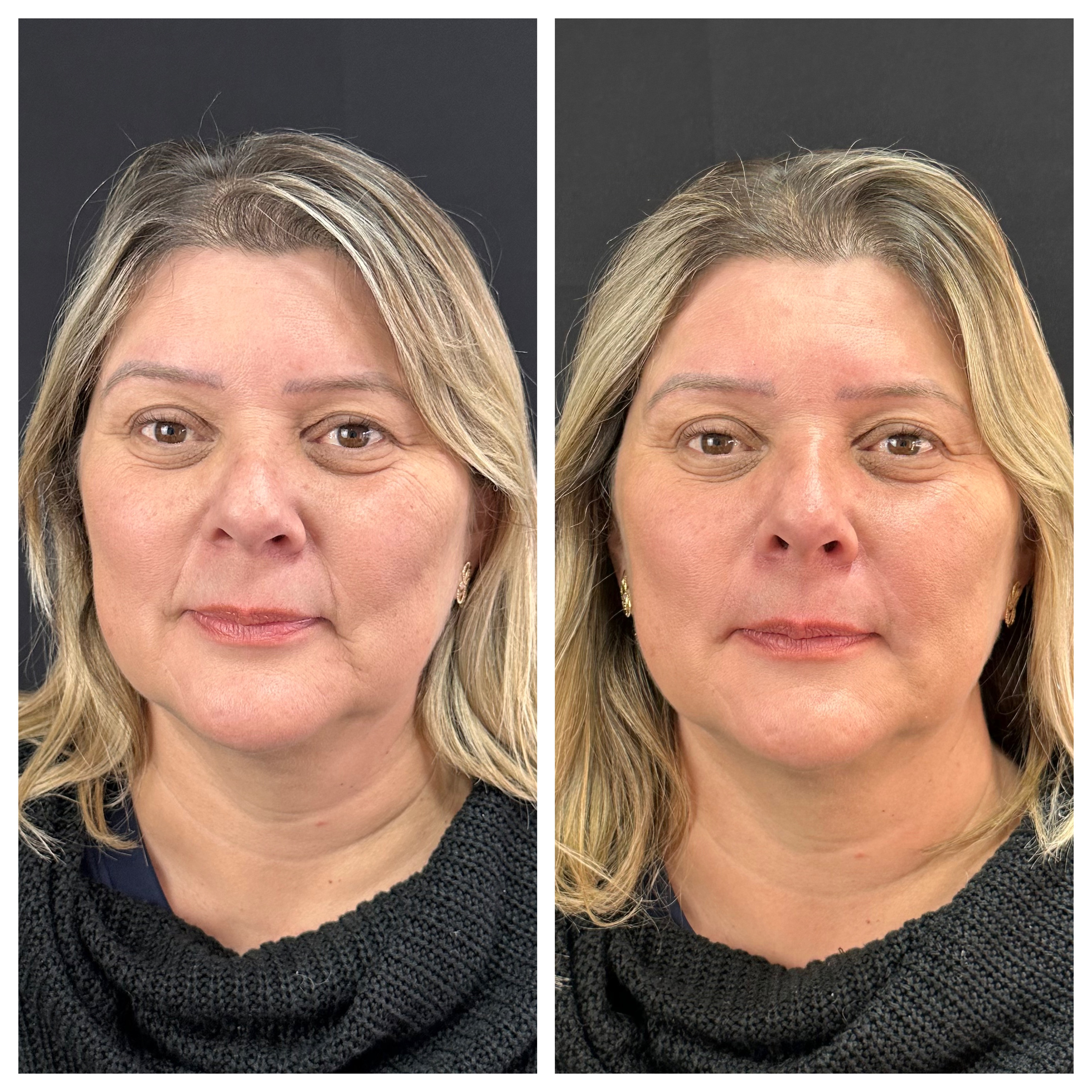 Resultado Harmonização Facial