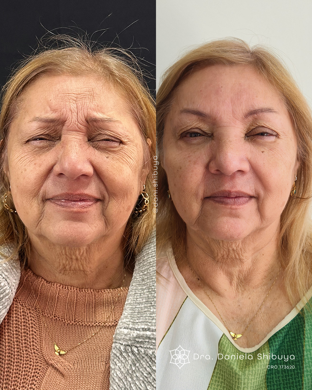 Resultado Harmonização Facial